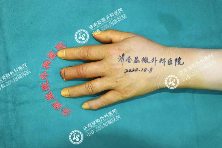 关于球员黄威手术情况通报：手术时间现已确定，计划10月10日进行