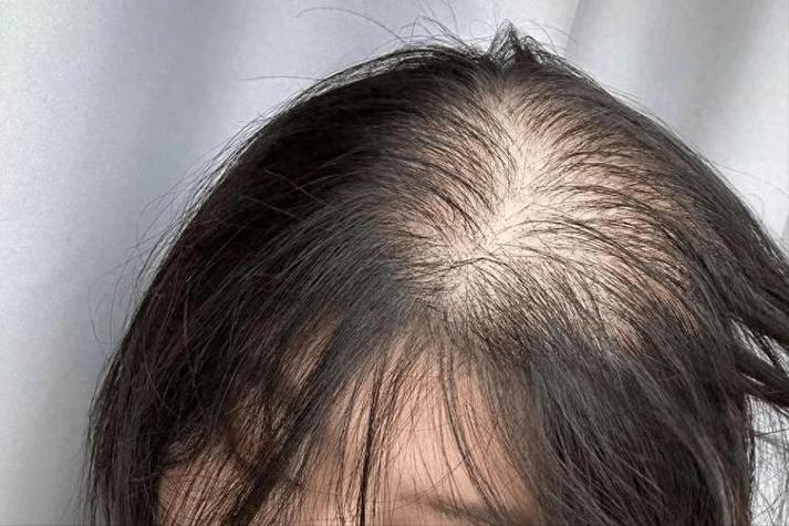 当你秃然发现自己开始掉头发：先是否认→到挣扎→再到接受事实